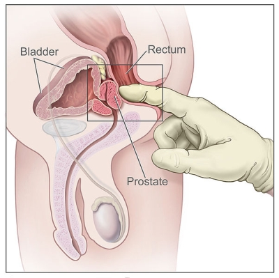 Digital Rectal Exam