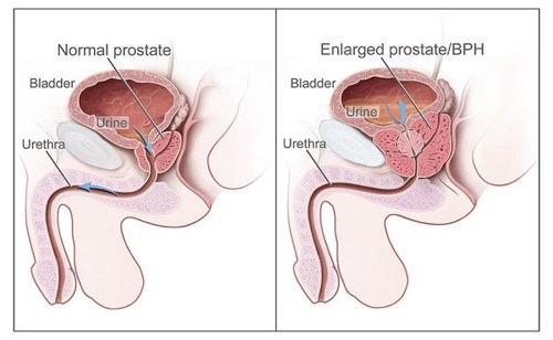 Diagram of enlarged prostate