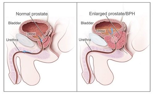 enlarged-prostate